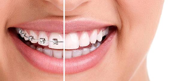 Aligners & Braces in Kharghar at Dental and Aesthetic by Dr. Mavleen