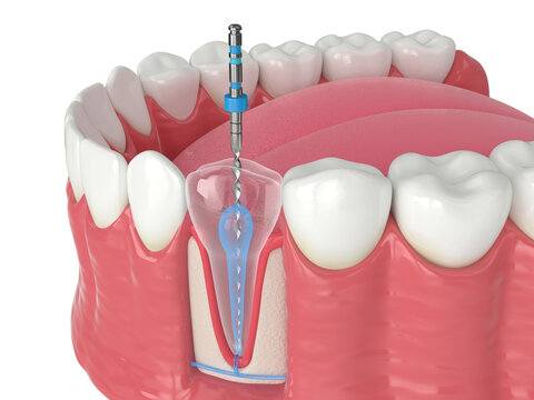 Painless Root Canal in Kharghar at Dental and Aesthetic by Dr. Mavleen