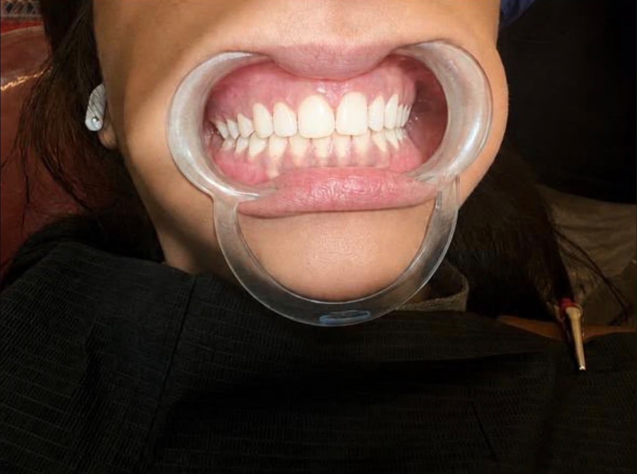 Healthy pink gums after gum depigmentation treatment in Kharghar