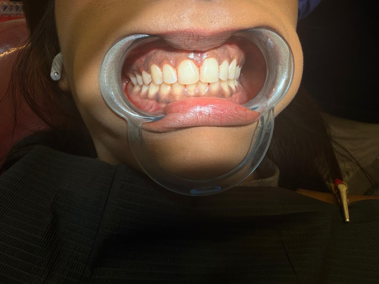 Dark pigmented gums before gum depigmentation treatment in Kharghar