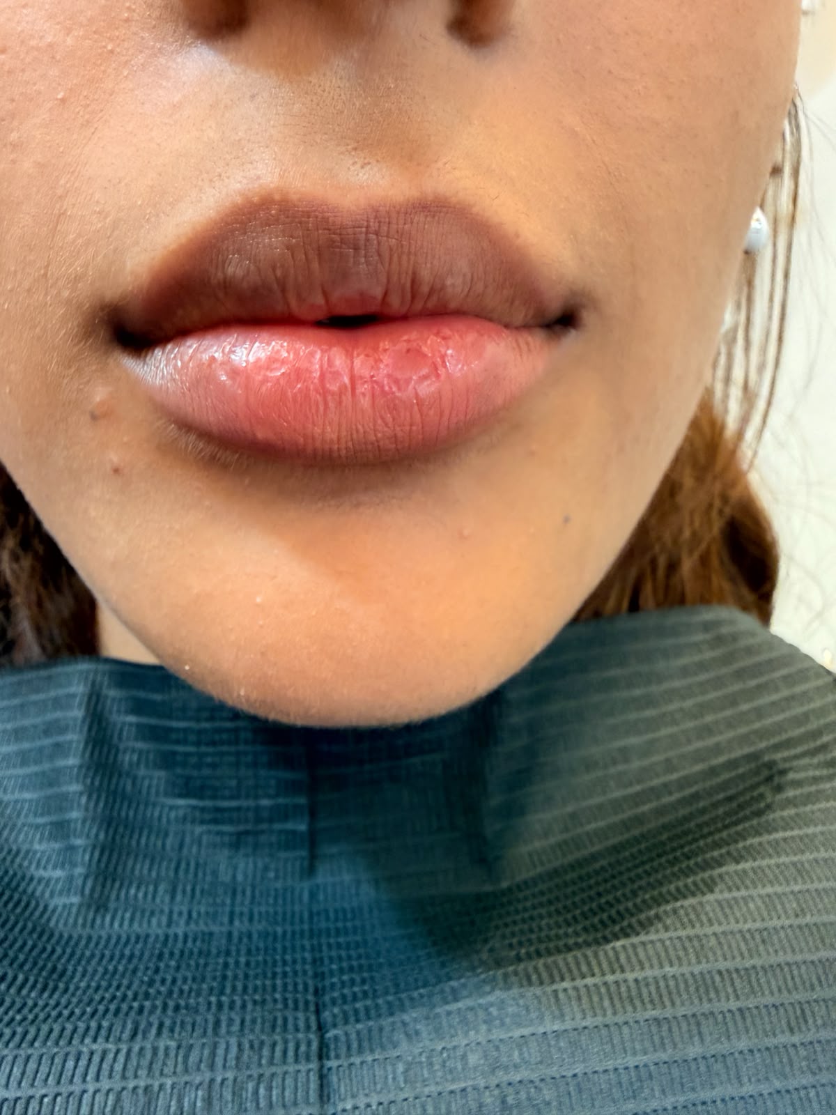 Patient's lips after lip tint and lip filler treatment in Sector 20 Kharghar