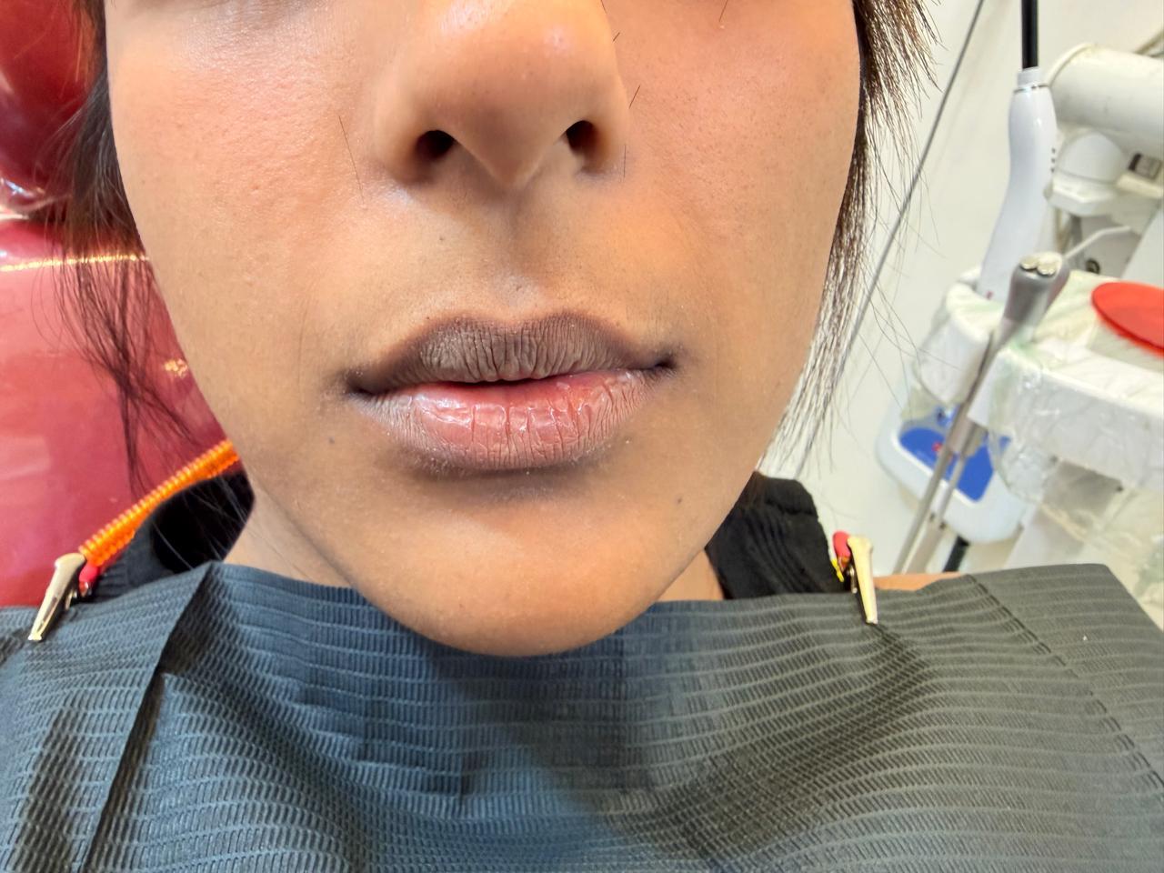 Patient's dark pigmented lips before lip tint treatment at Kharghar clinic